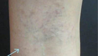 _0003_0001_Laser-Vein-Removal-patient-1.jpg