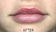 _0003_Dermal-filler-Juvederm-2-2