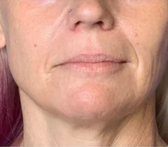 _0003_laser-skin-resurfacing-before-and-after-two-1000×1000