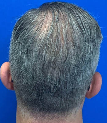 _0003_neograft-fue-before-and-after-photos-1000×1000