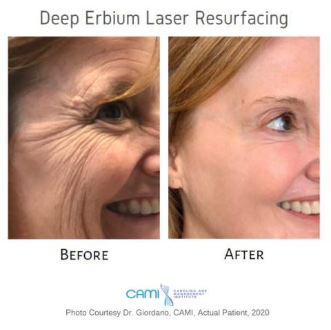 Laser Skin Resurfacing case #71740