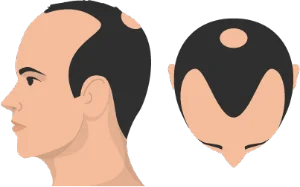 Stage 4 hair loss