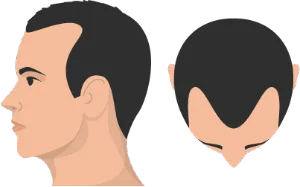 Stage 3 hair loss - first signs of balding