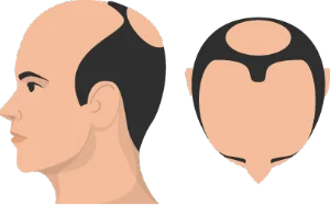 Stage 6 hair loss