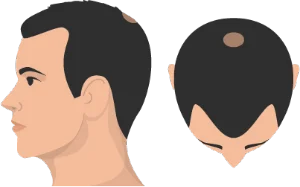 Stage 3 Vertex of hair loss illustration - most severe loss