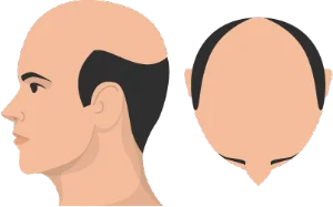 Stage 7 of hair loss illustration - most severe loss