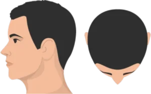 Stage 1 of hair loss illustration