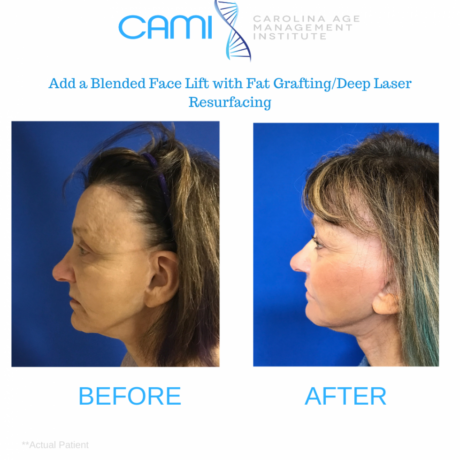 Laser Skin Resurfacing case #71741