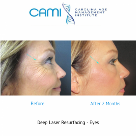 Laser Skin Resurfacing case #71746