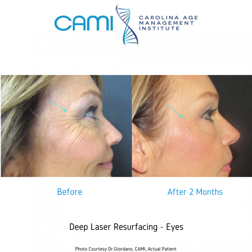 Laser Skin Resurfacing case #71746