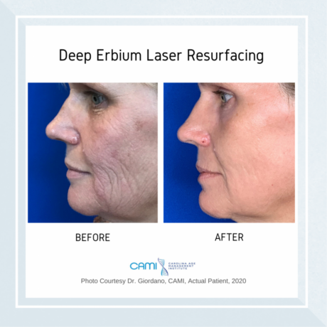 Laser Skin Resurfacing case #71744