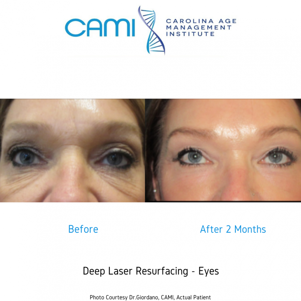 Laser Skin Resurfacing case #71742