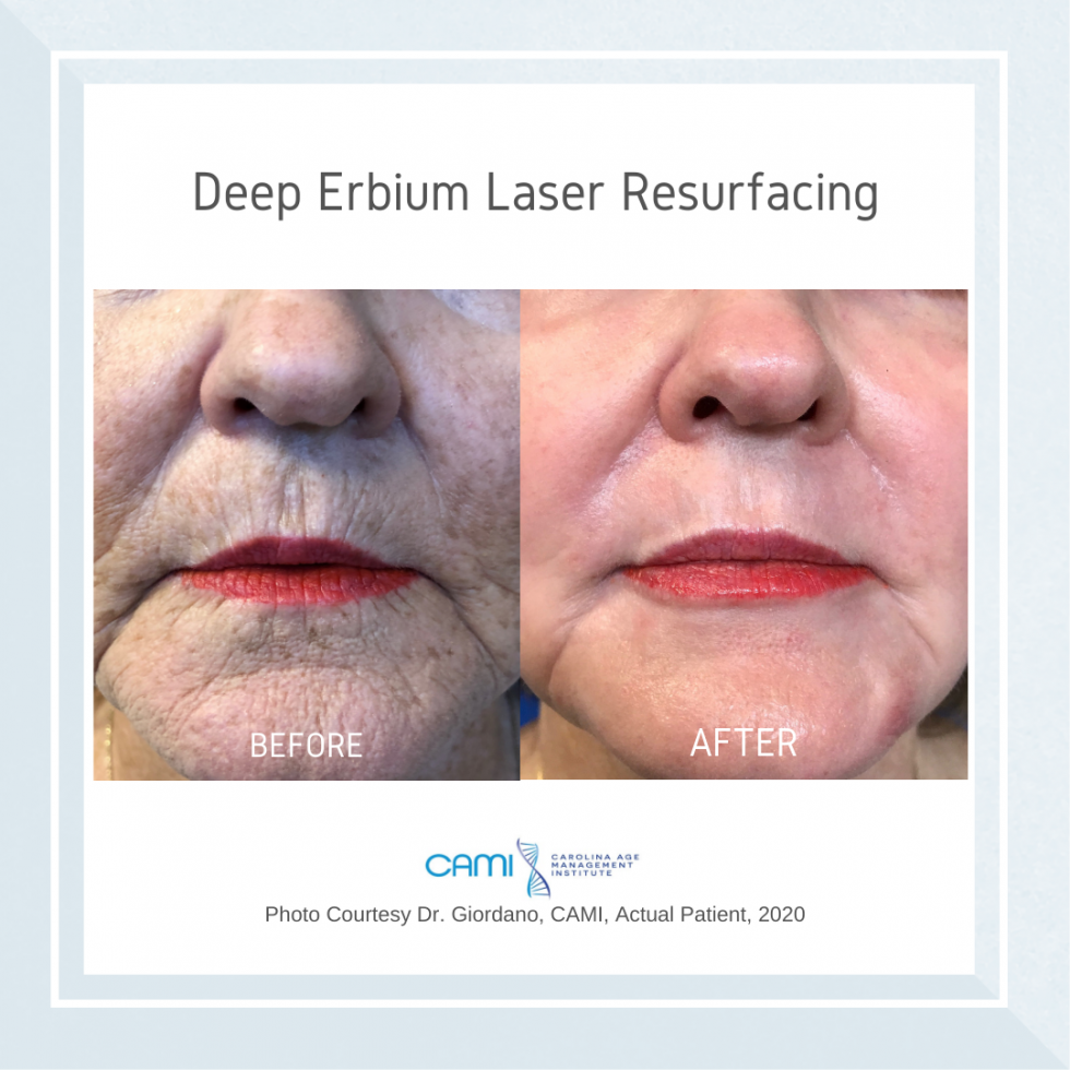 Laser Skin Resurfacing case #71732