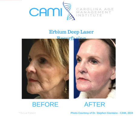 Laser Skin Resurfacing case #71734