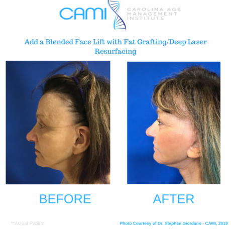 Laser Skin Resurfacing case #71741