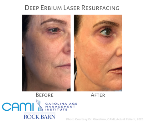 Laser Skin Resurfacing case #71736