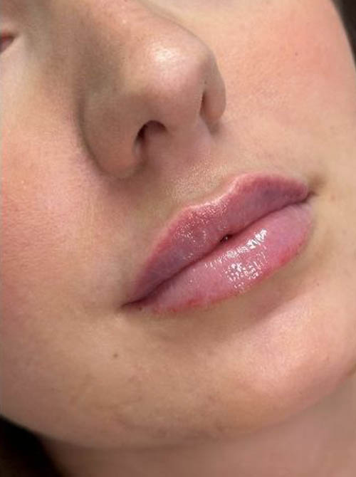 Laser Resurfacing – on drive – lip filler before/after