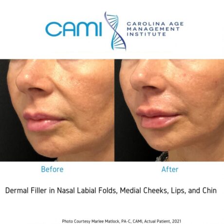 Liquid Facelift case #71722