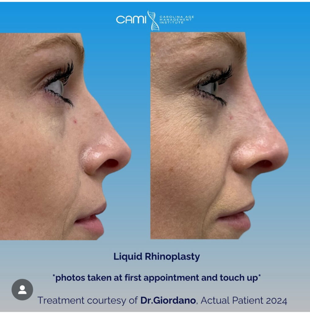 Liquid Rhinoplasty case #72658