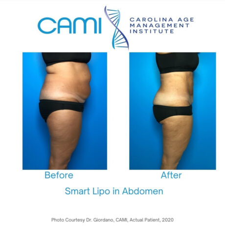 SmartLipo case #72526