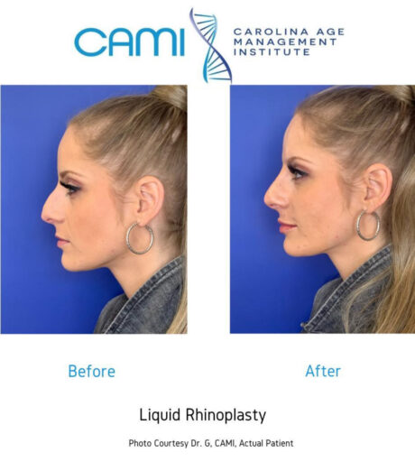 Liquid Rhinoplasty case #72645