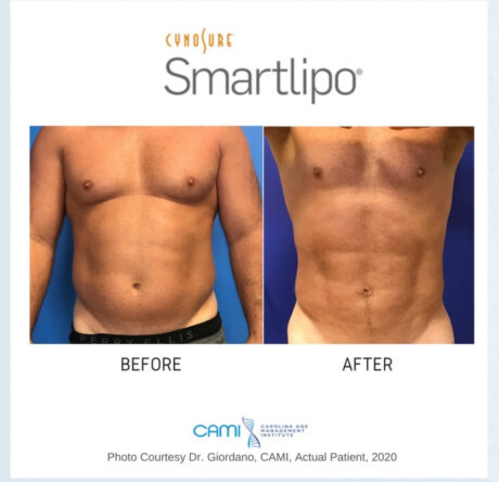 SmartLipo case #72534