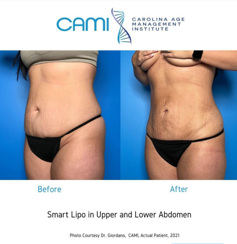 SmartLipo case #72532