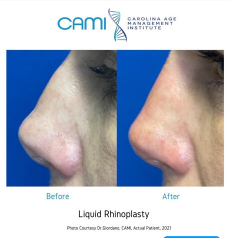 Liquid Rhinoplasty case #72643