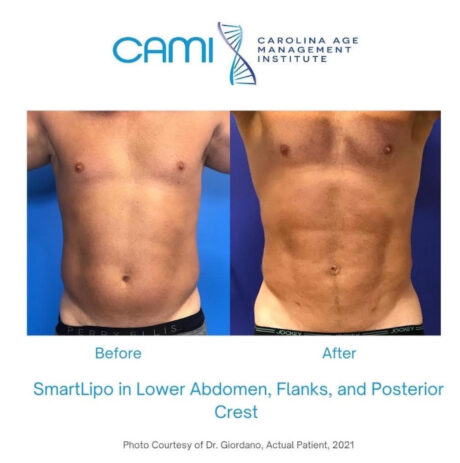 SmartLipo case #72530