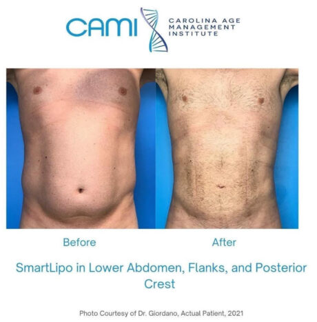 SmartLipo case #72528