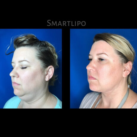 SmartLipo case #72538