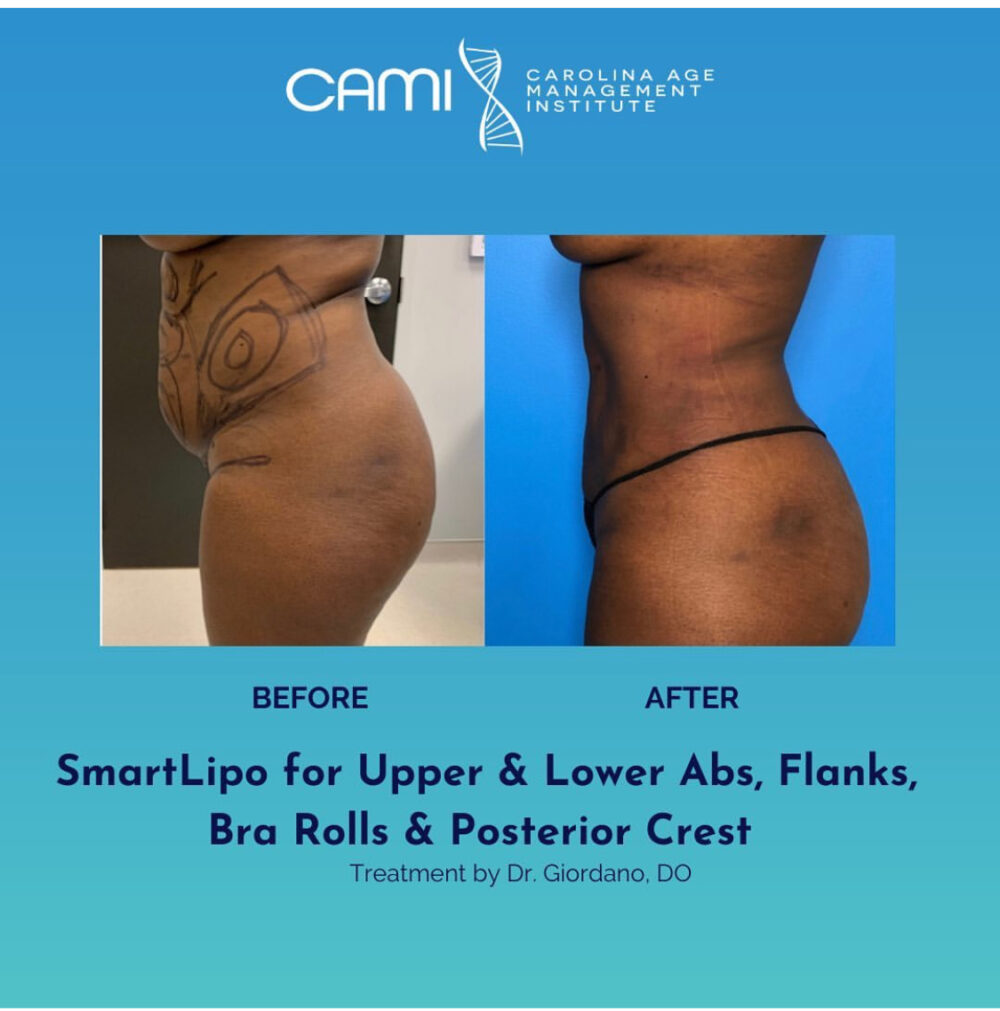 SmartLipo case #72553