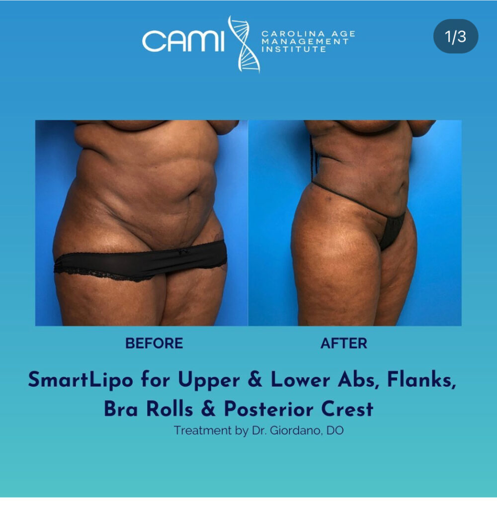 SmartLipo case #72553