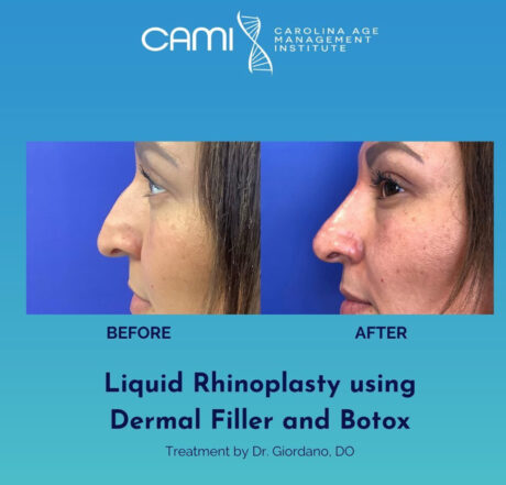 Liquid Rhinoplasty case #72656