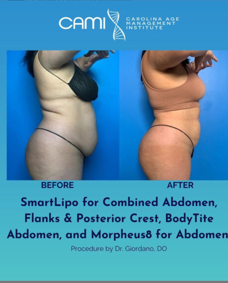 SmartLipo case #72556