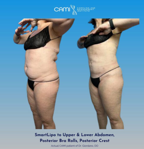 SmartLipo case #72558