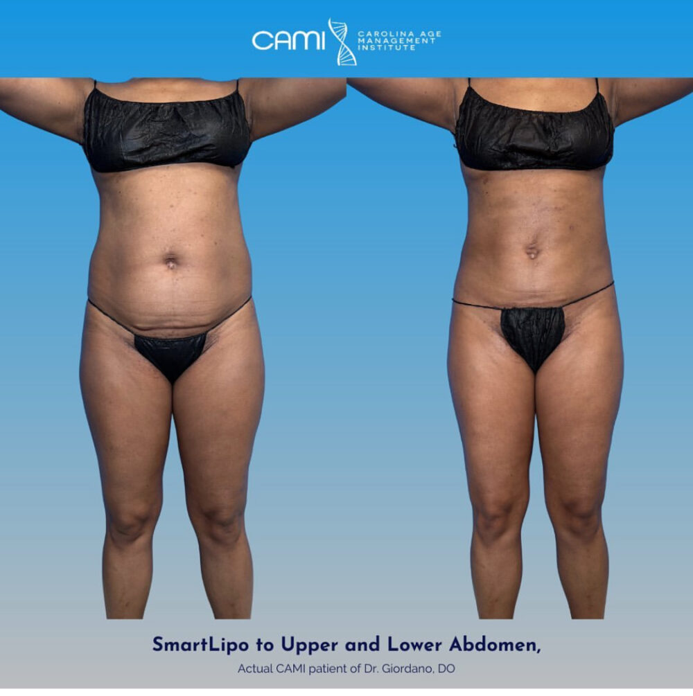 SmartLipo case #72561