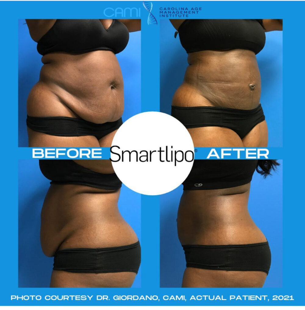 SmartLipo case #72545