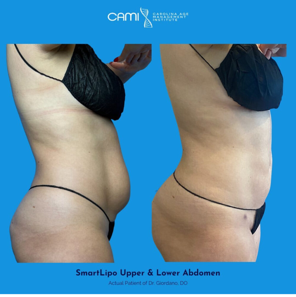 SmartLipo case #72565