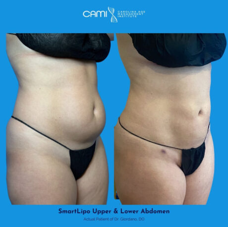 SmartLipo case #72565