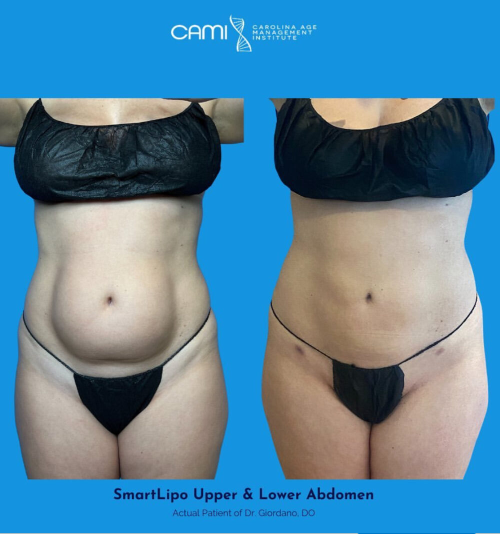 SmartLipo case #72565