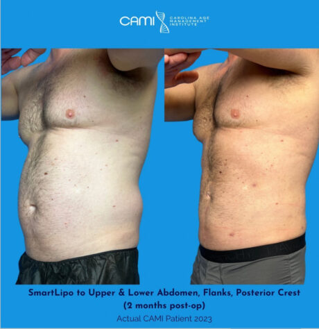 SmartLipo case #72569