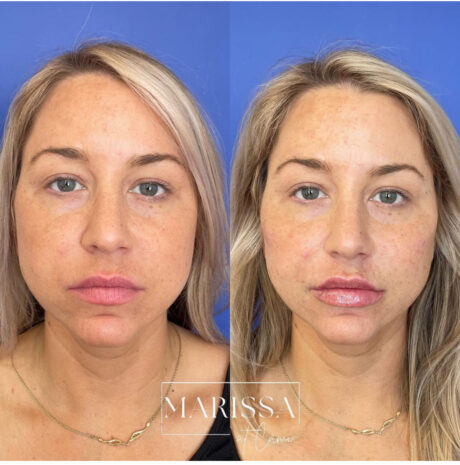 Dermal Fillers case #72500