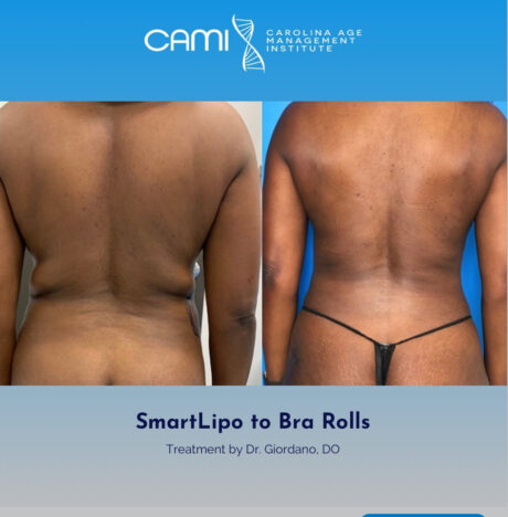 SmartLipo case #72576