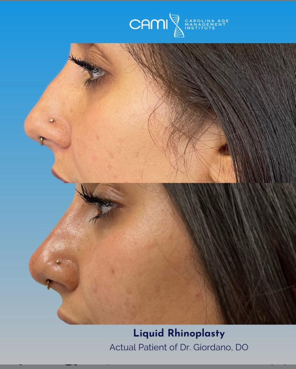 Liquid Rhinoplasty case #72654