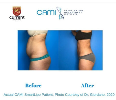 SmartLipo case #72536