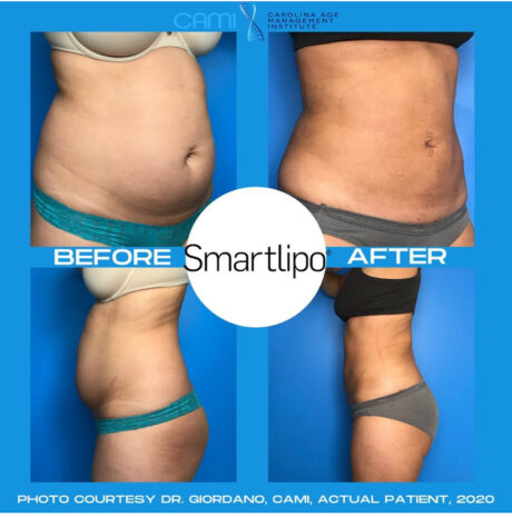 SmartLipo case #72547