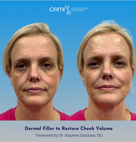 Dermal Fillers case #72502