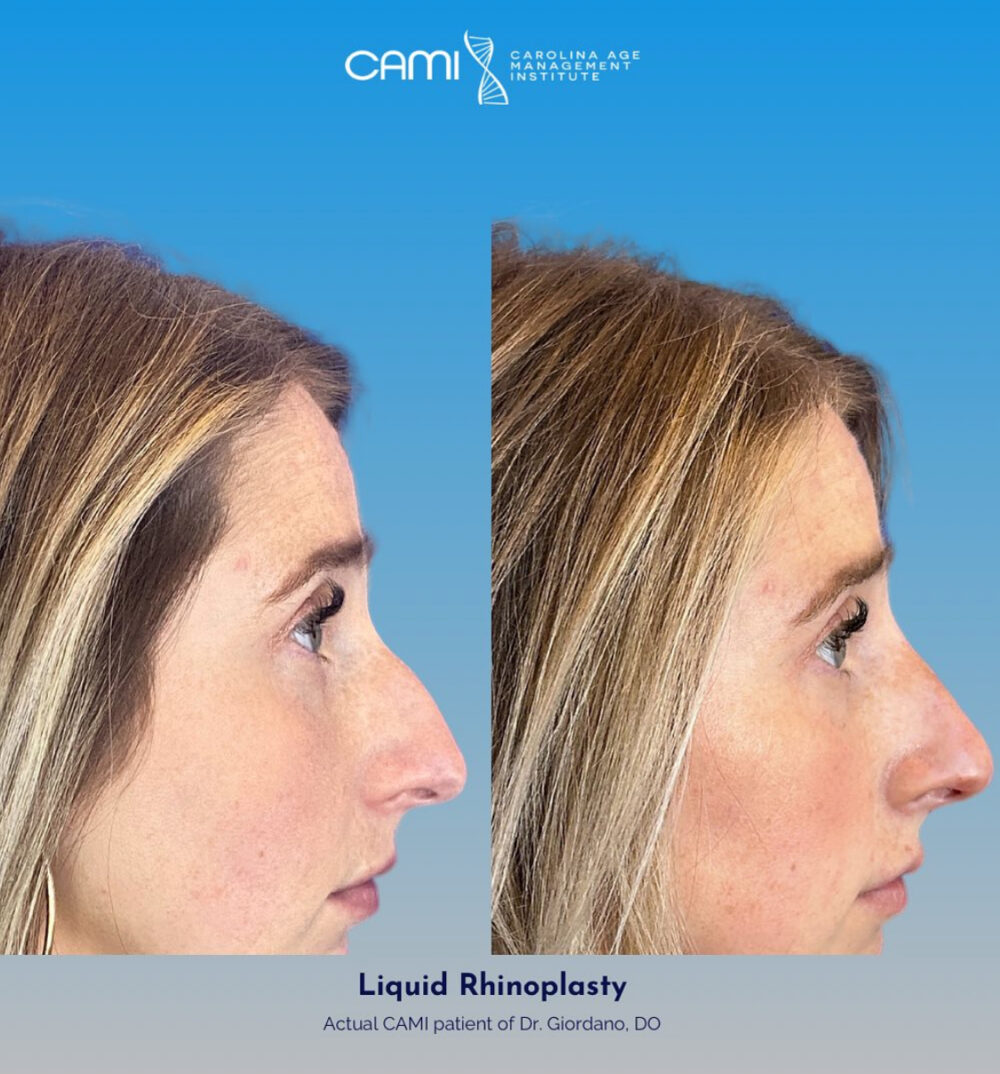 Liquid Rhinoplasty case #72652