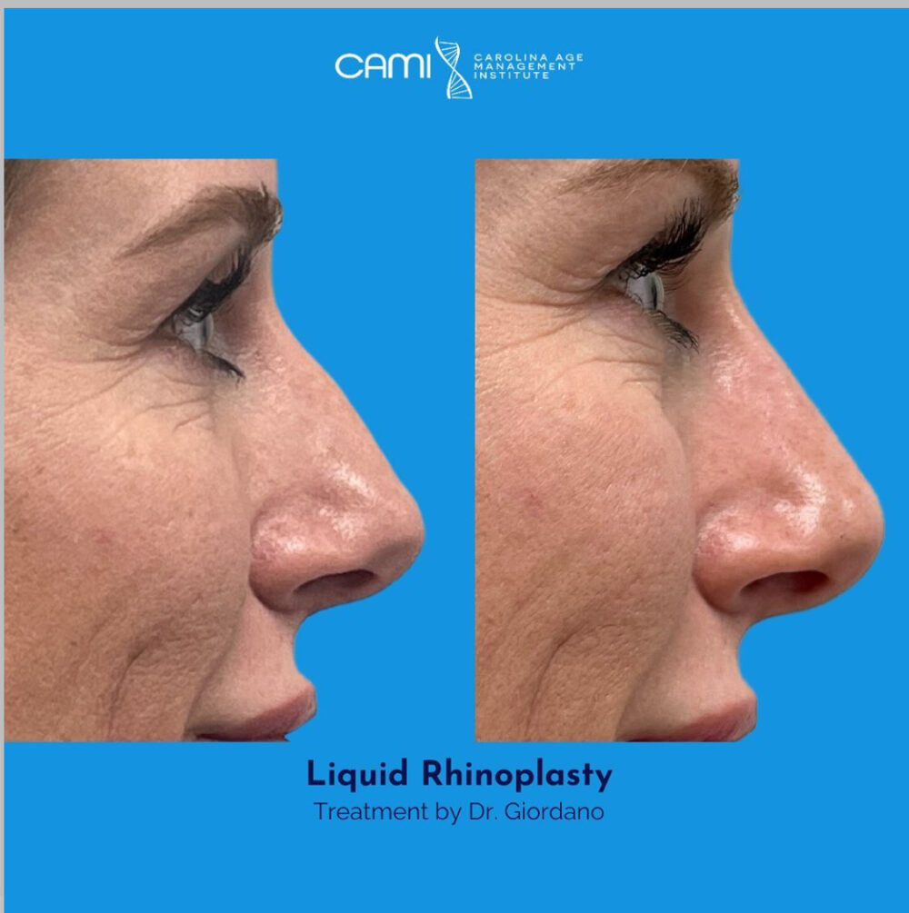 Liquid Rhinoplasty case #72650